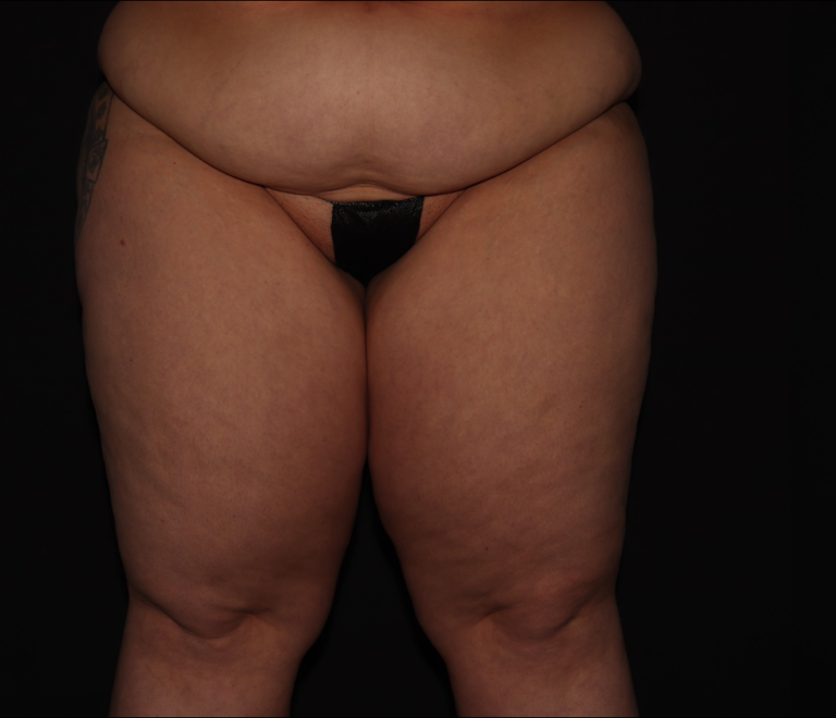 Before Image: Thighs - front