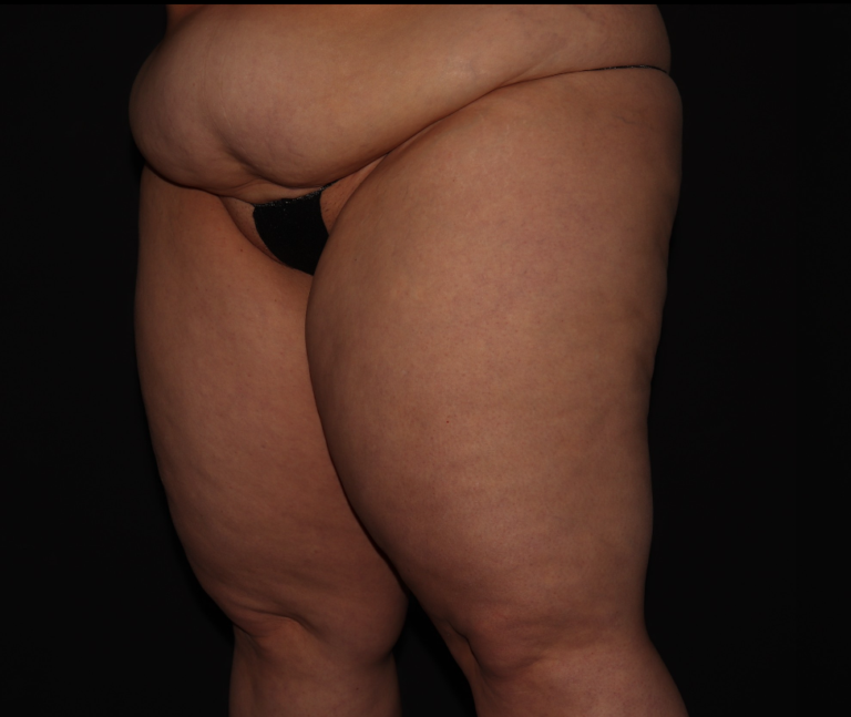 Before Image: Thighs - left-front-oblique