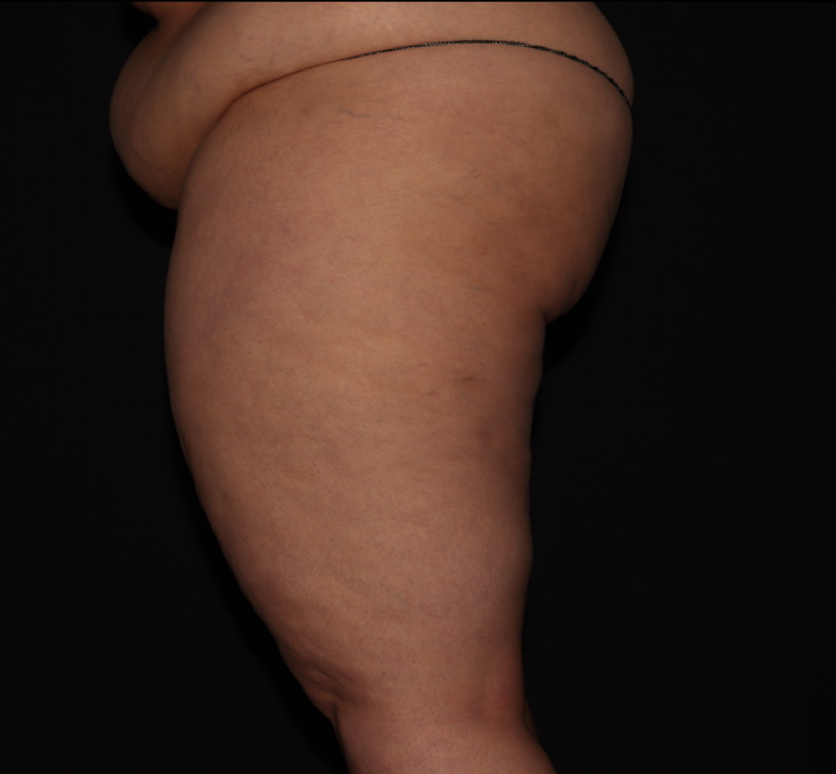 Before Image: Thighs - left-side