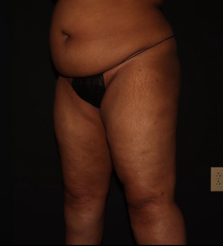 After Image: Thighs - left-front-oblique