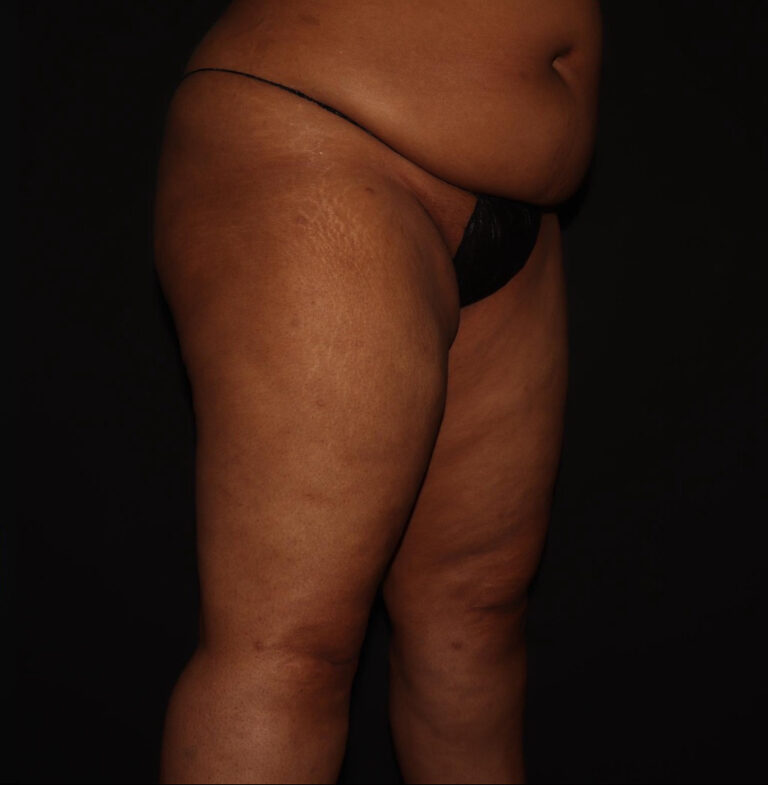 After Image: Thighs - right-front-oblique
