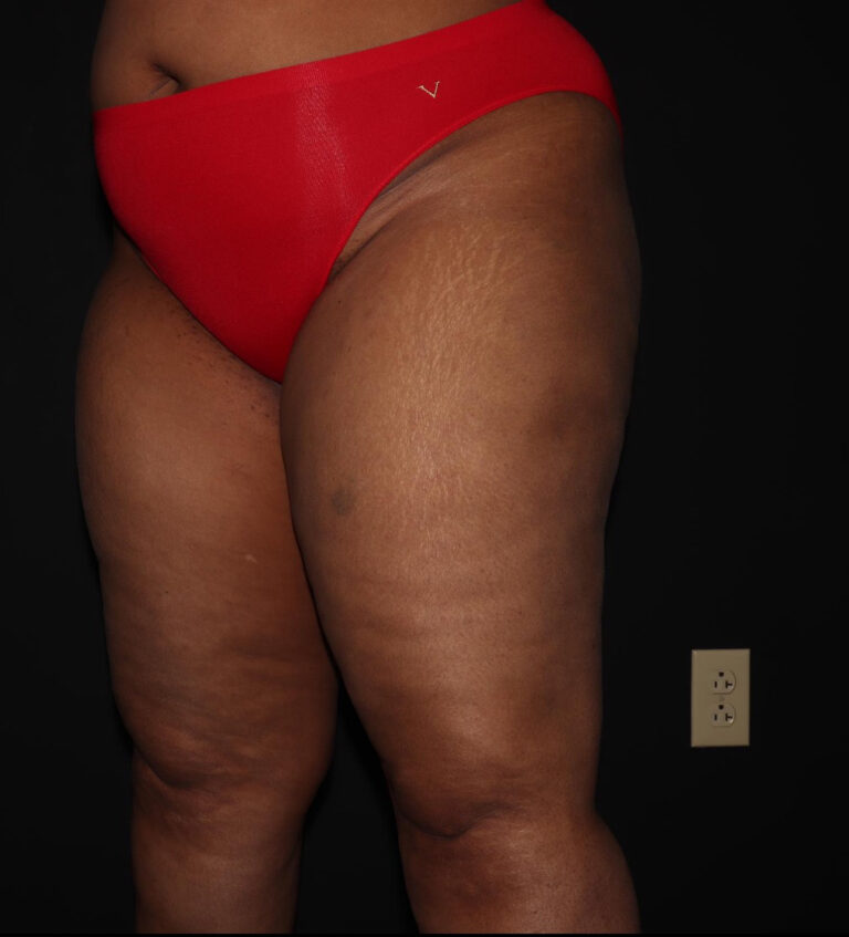 Before Image: Thighs - left-front-oblique