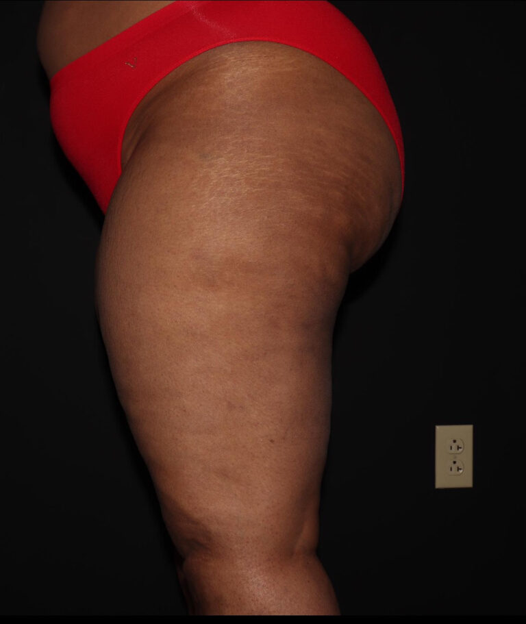Before Image: Thighs - left-side