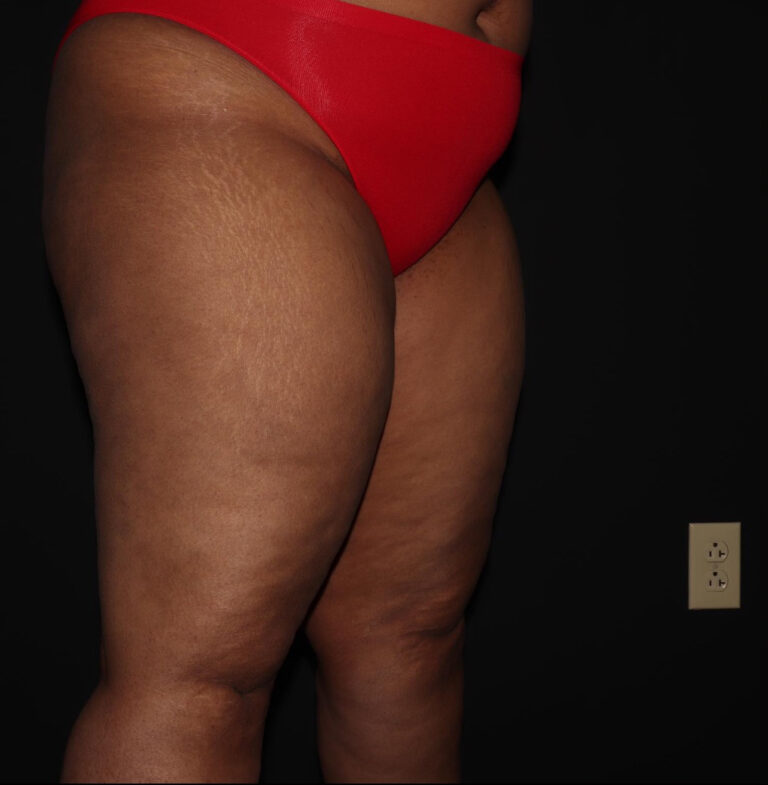Before Image: Thighs - right-front-oblique