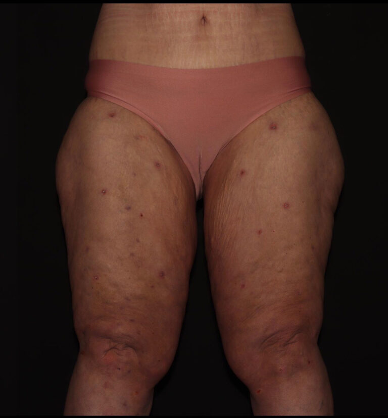 After Image: Thighs - front