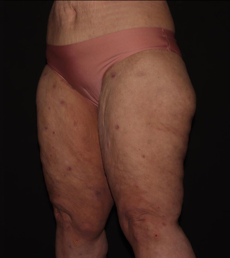 After Image: Thighs - left-front-oblique