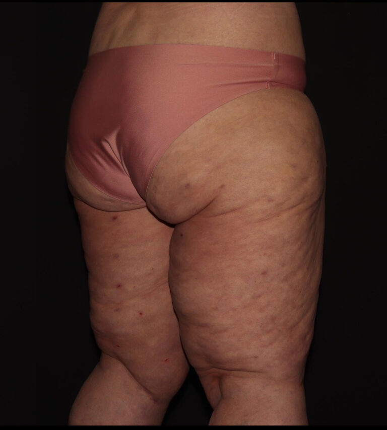 After Image: Thighs - right-back-oblique