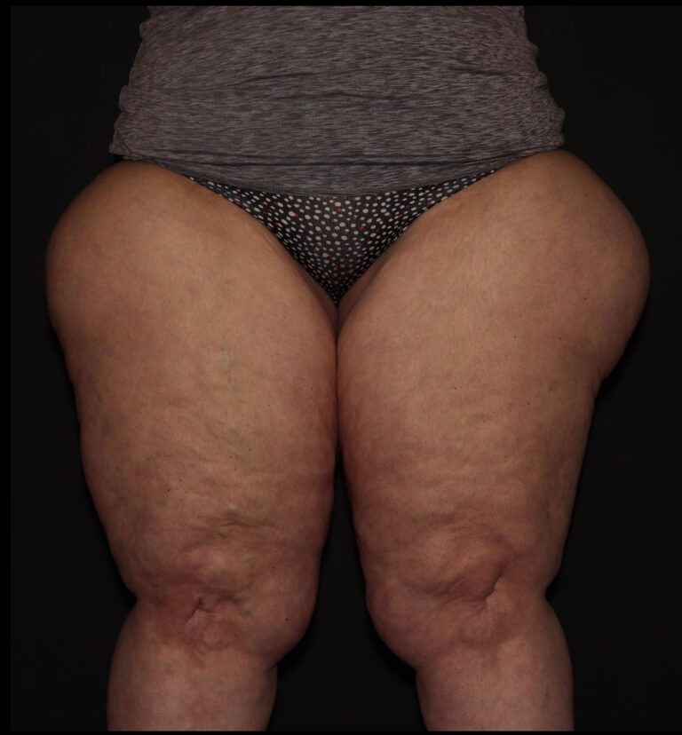 Before Image: Thighs - front