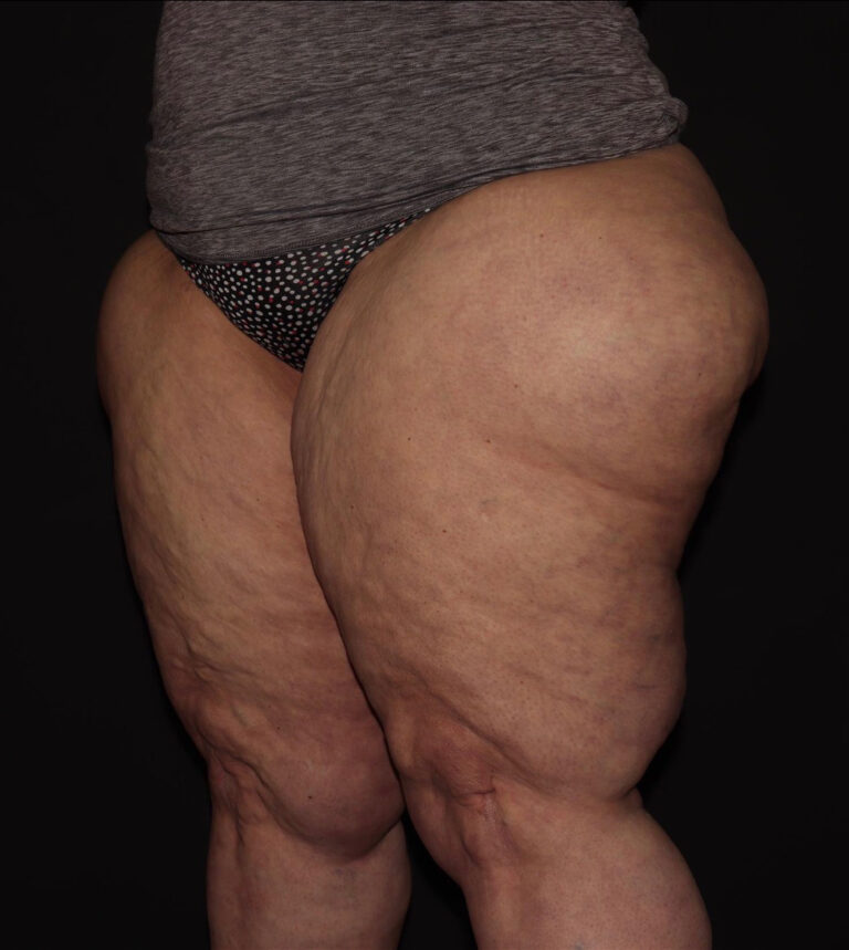 Before Image: Thighs - left-front-oblique