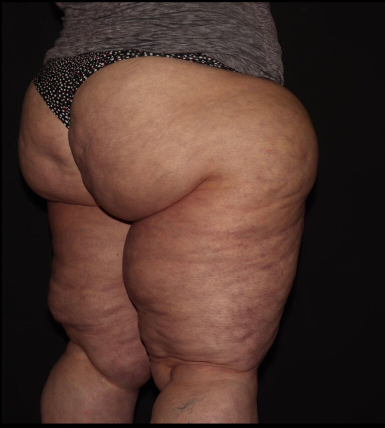 Before Image: Thighs - right-back-oblique
