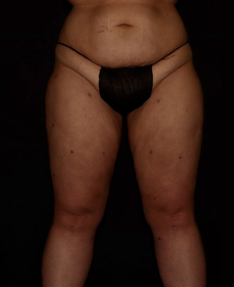 After Image: Thighs - front