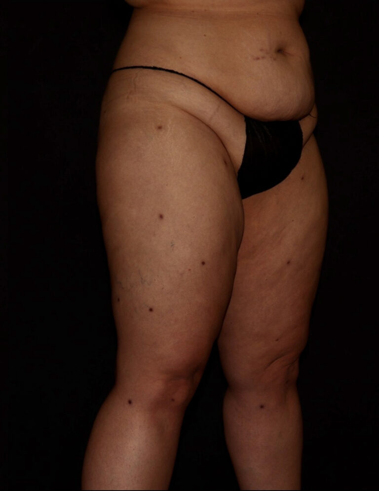 After Image: Thighs - right-front-oblique
