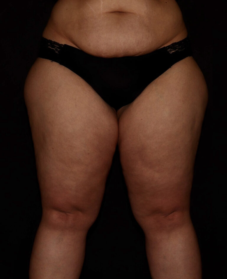 Before Image: Thighs - front