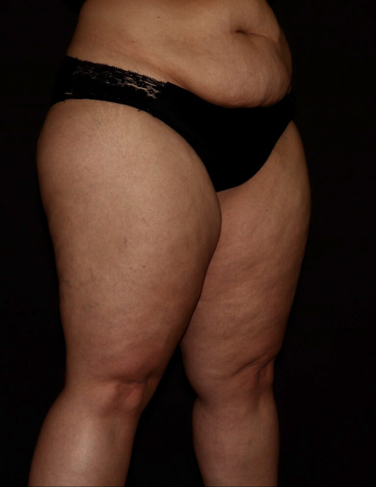 Before Image: Thighs - right-front-oblique