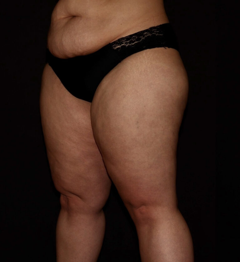 Before Image: Thighs - left-front-oblique