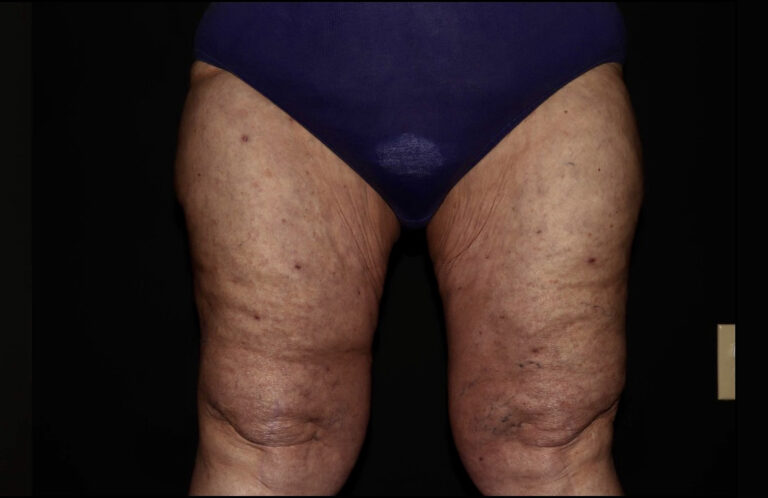 After Image: Thighs - front