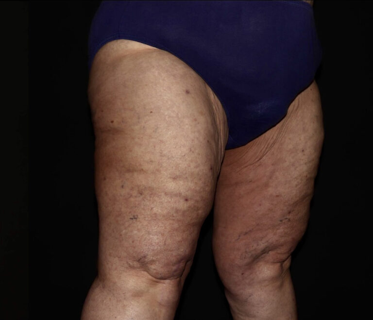 After Image: Thighs - right-front-oblique