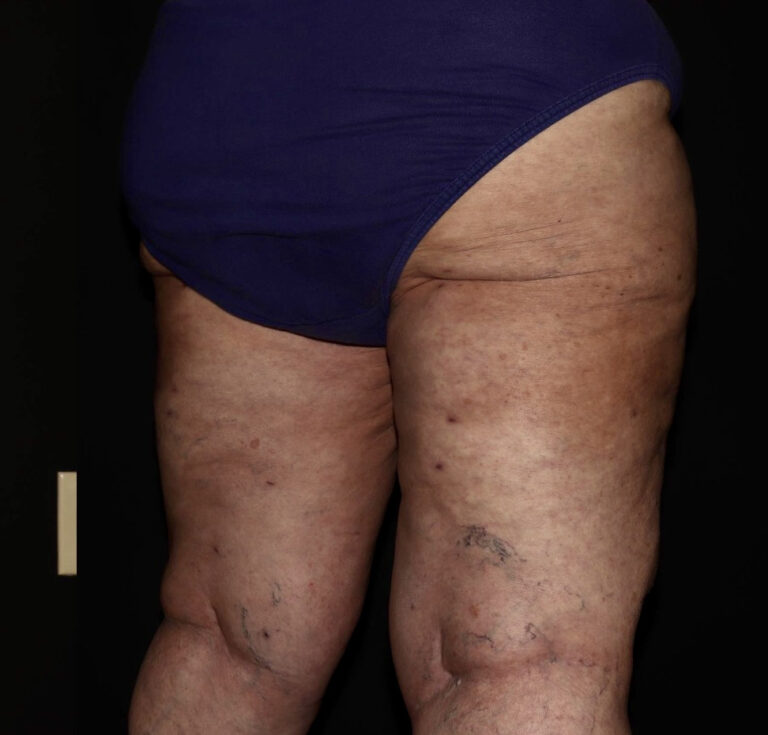 After Image: Thighs - right-back-oblique