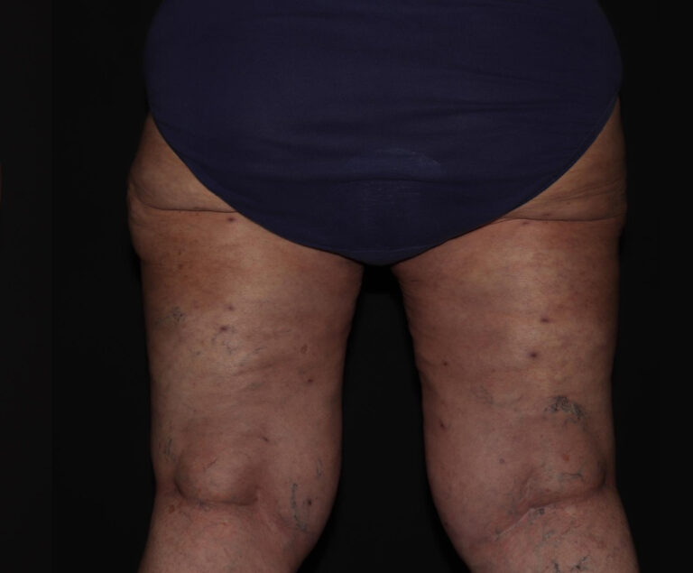After Image: Thighs - back