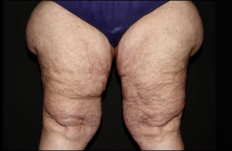 Before Image: Thighs - front