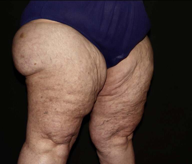 Before Image: Thighs - right-front-oblique