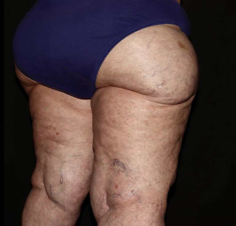 Before Image: Thighs - right-back-oblique