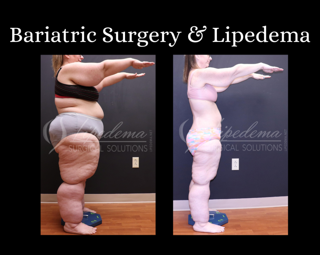 Bariatric Surgery & Lipedema Dr Wright St Louis Lipedema Treatment