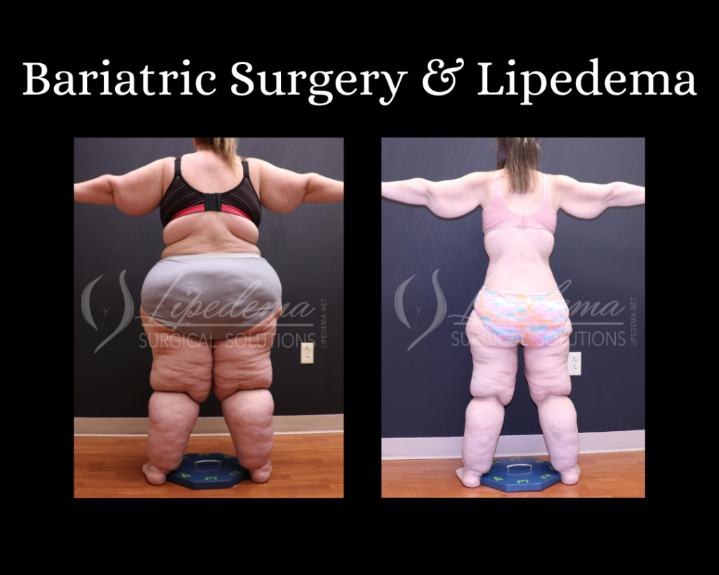 Bariatric Surgery & Lipedema Dr Wright St Louis Lipedema Treatment (2)