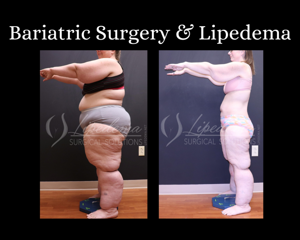 Bariatric Surgery & Lipedema Dr Wright St Louis Lipedema Treatment (3)