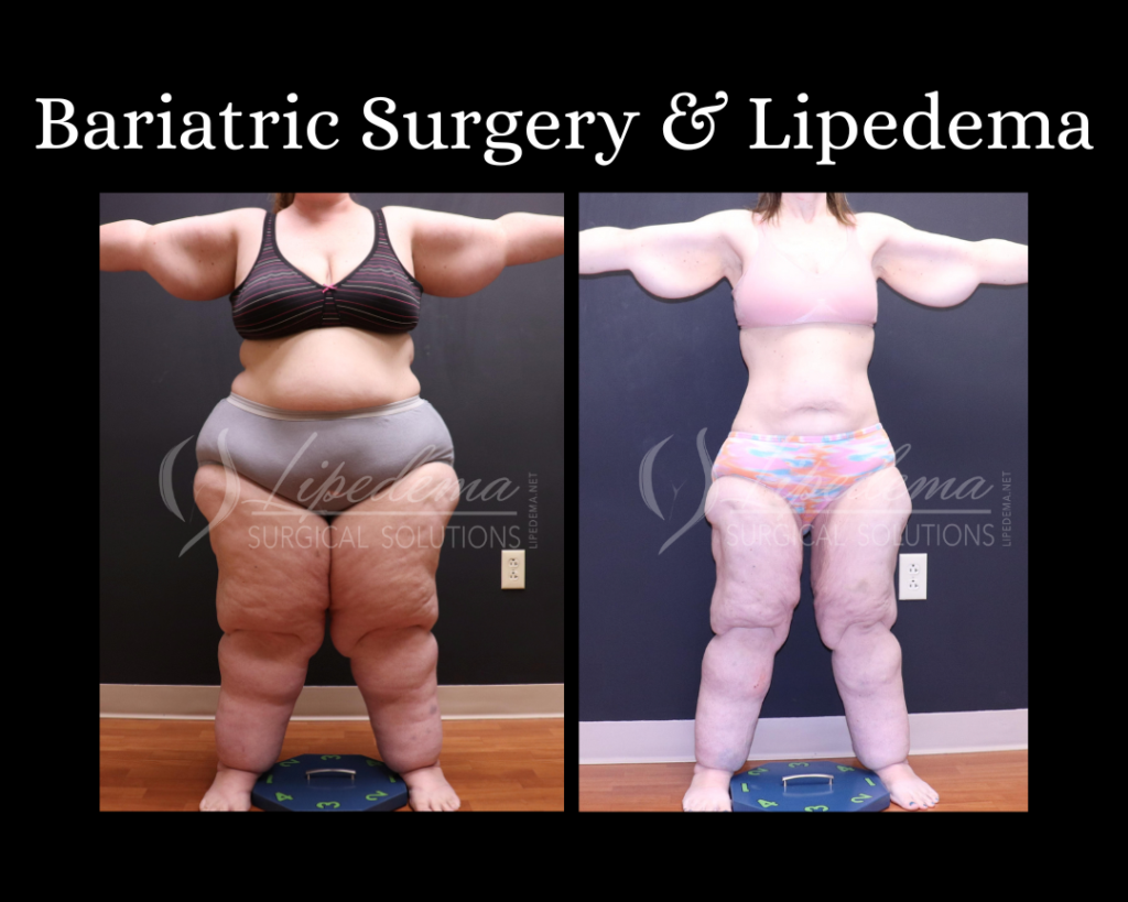 Bariatric Surgery & Lipedema Dr Wright St Louis Lipedema Treatment (4)