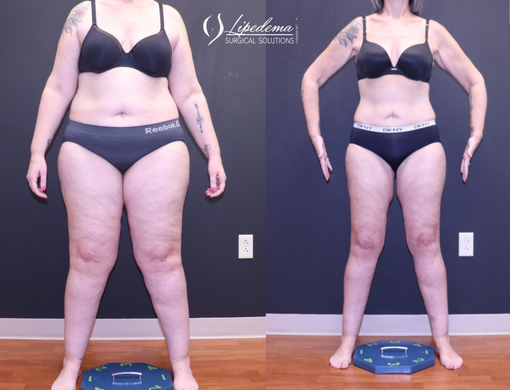 GLP1 Lipedema Patient Transformation