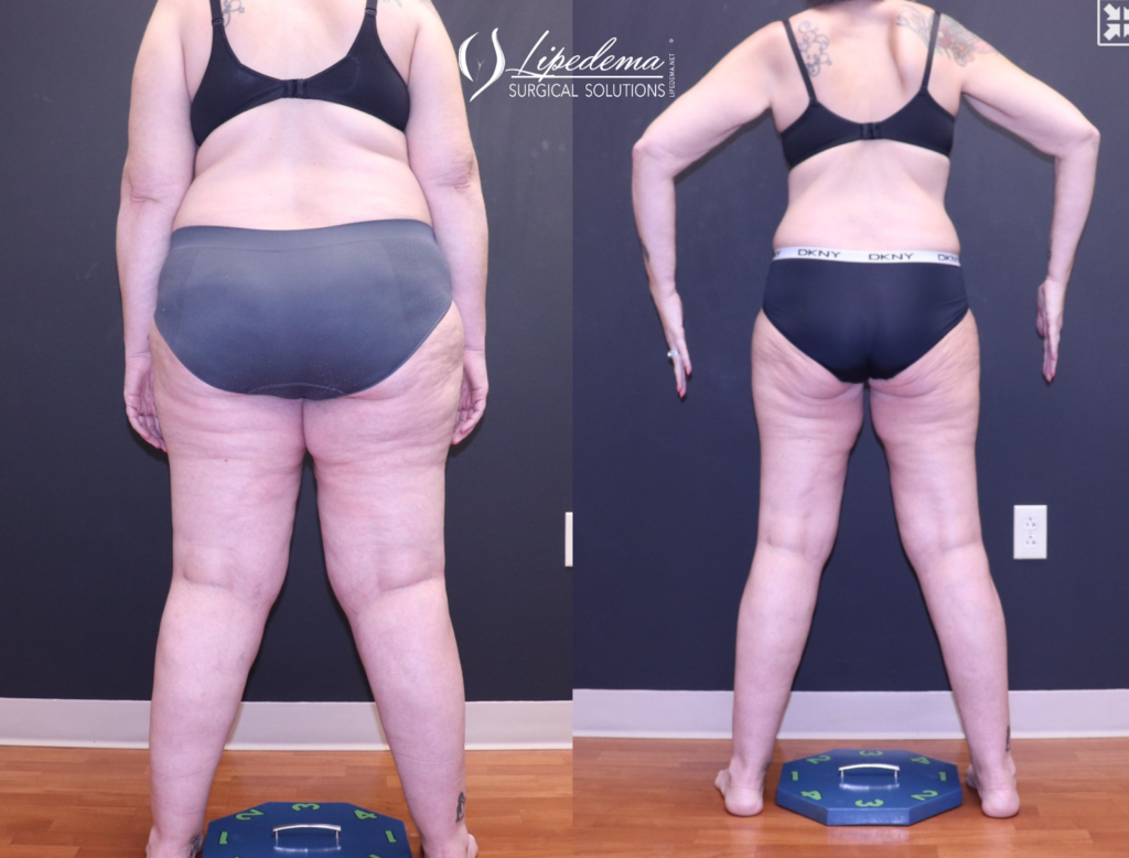 GLP1 Lipedema Patient Transformation2