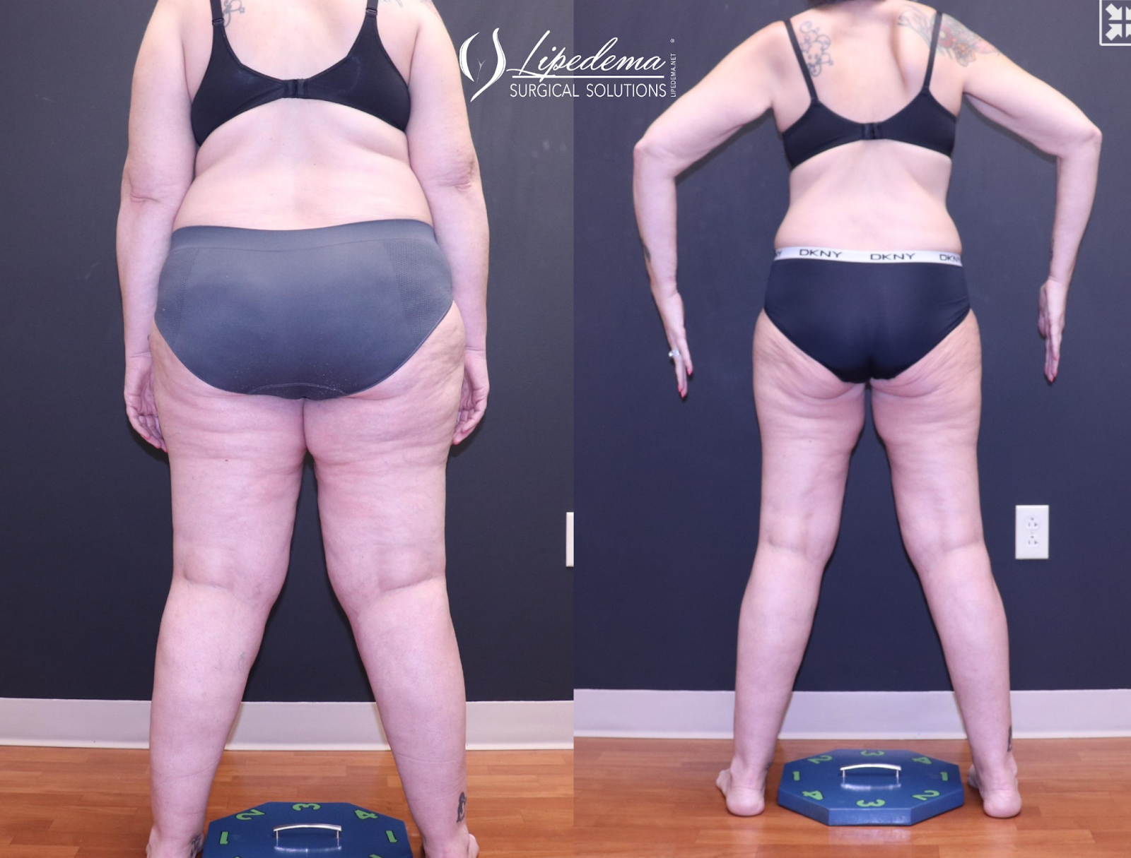 glp 1 in thigh Patient Success Story: Transformative Results with GLP-1 Conservative  Therapy for Lipedema