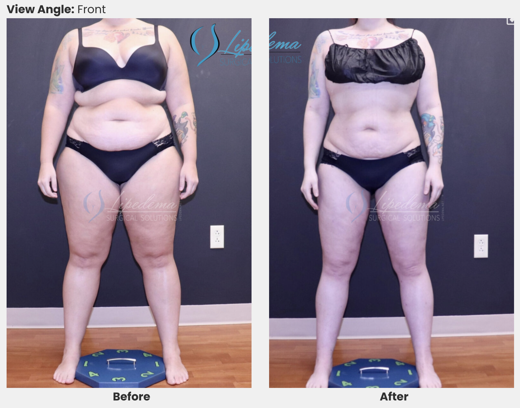Lipedema Surgical Solutions Lipedema Reduction Liposuction Surgery before and after Dr Wright