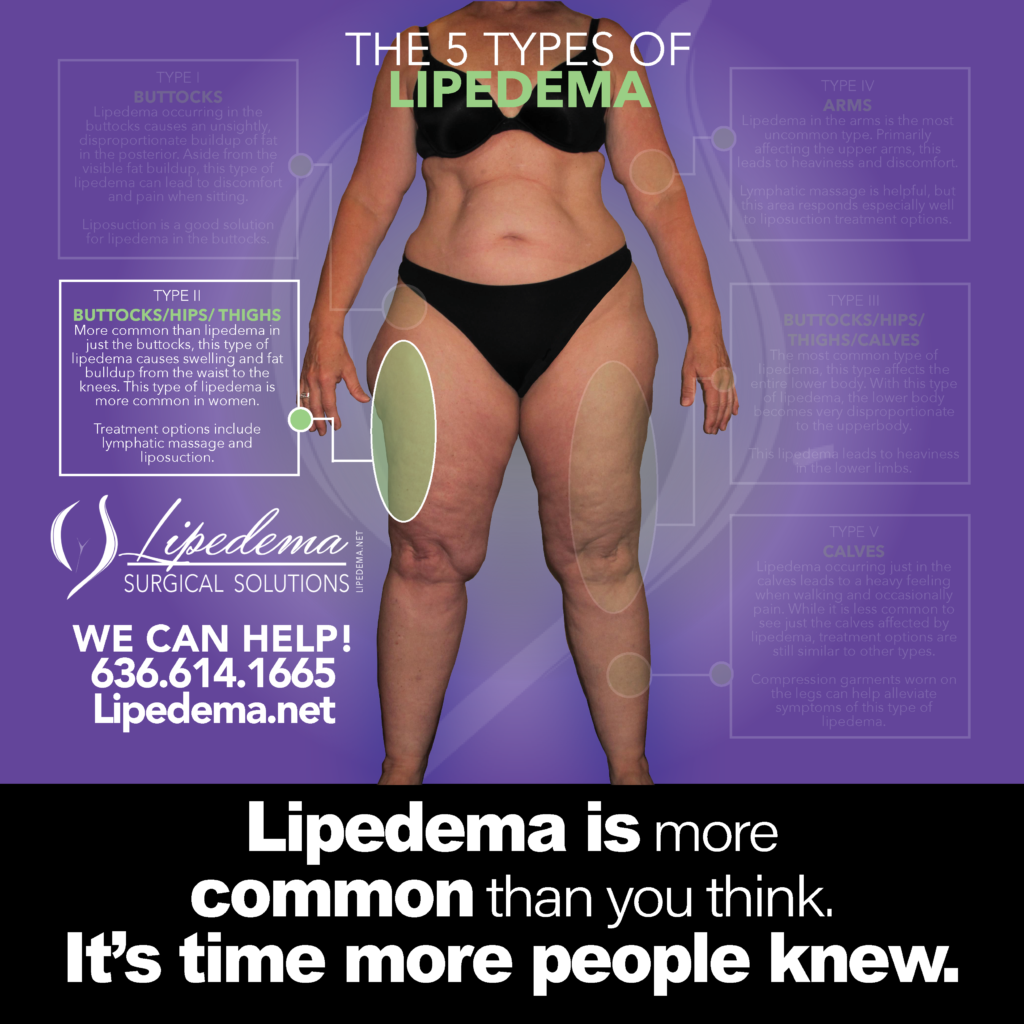 LSS 2026 2 February Lipedema Awarness 800x8005